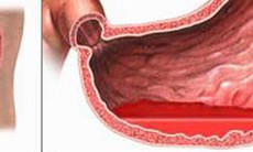 Lưu ý khi dùng thuốc cầm máu trong xuất huyết tiêu hóa cao